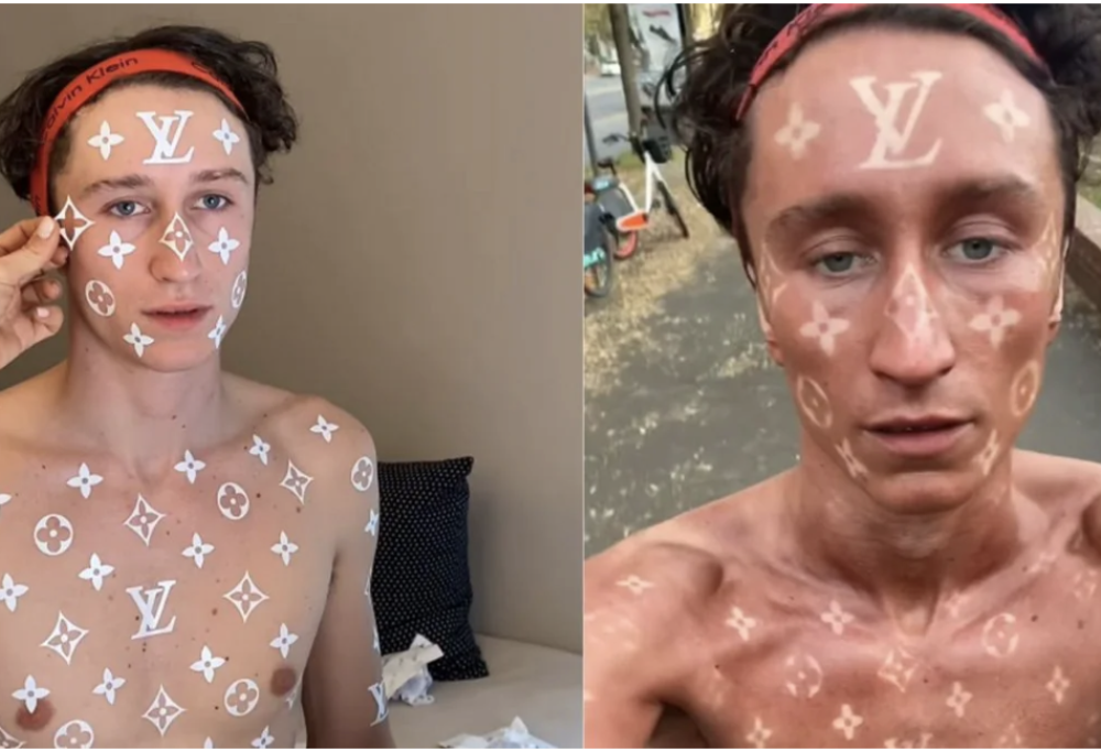 Si abbronza con il logo di Vuitton sulla pelle