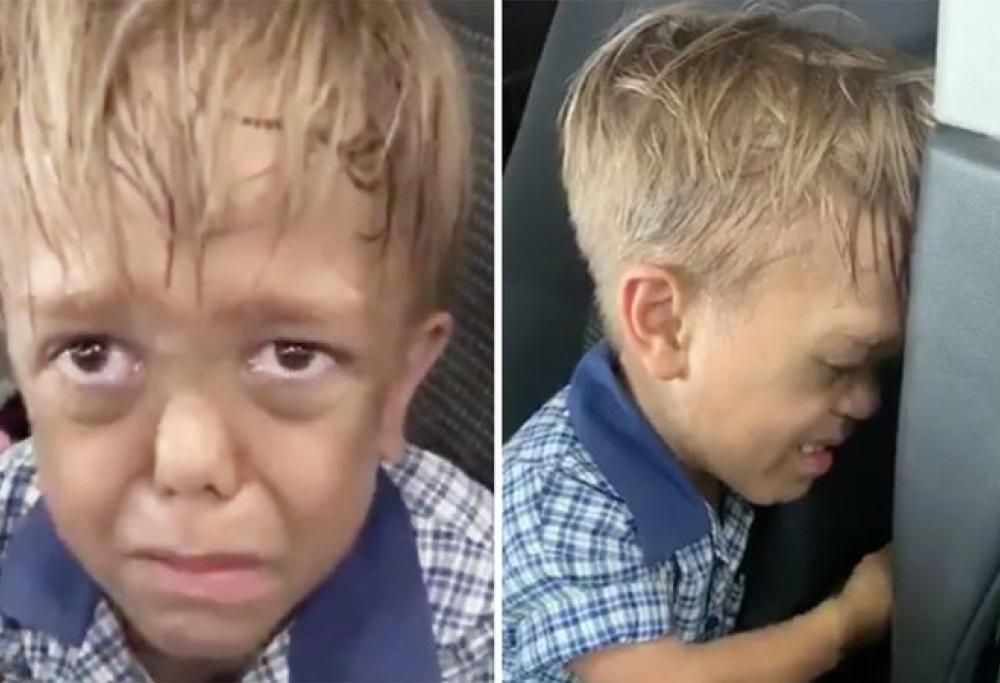 “Voglio morire”: madre mostra gli effetti del bullismo sul figlio affetto da nanismo