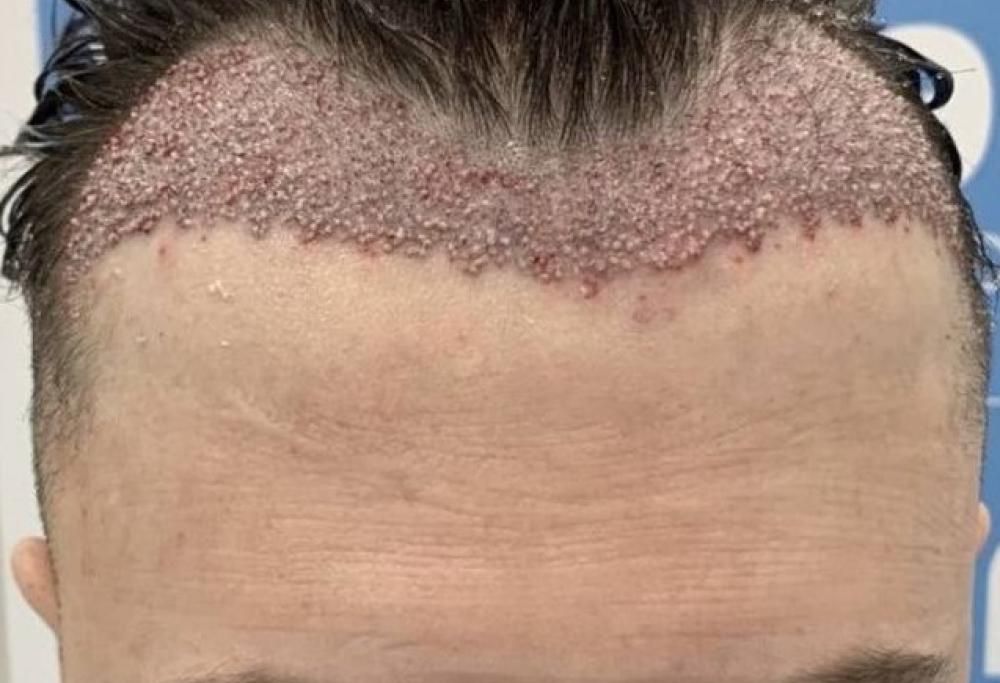 Ragazzo di 26 anni rimasto sfregiato dopo il trapianto dei capelli