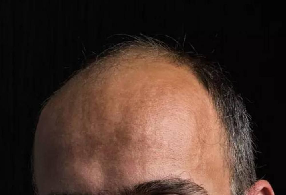 Gli uomini calvi potrebbero essere più a rischio di contrarre il Virus