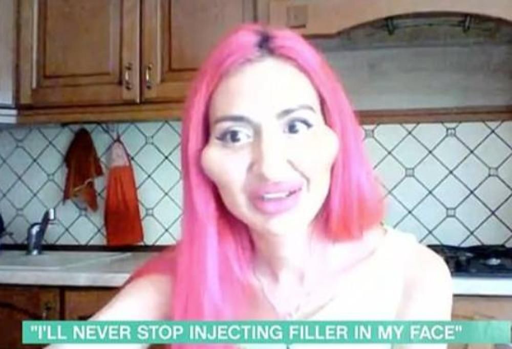 Donna si inetta più volte acido ialuronico in faccia e ammette di ricevere più attenzioni