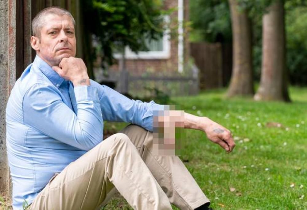 Uomo perde il pene e gli viene ricostruito sul braccio