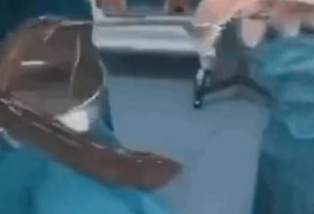 Rimuovono 38 cm di anguilla dall’ano di un uomo: l’aveva inserita per curare la costipazione