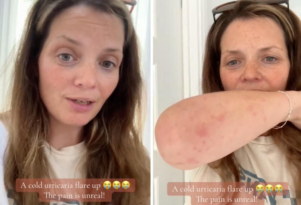 “Mi sentivo in fiamme”: la storia di una donna allergica al freddo