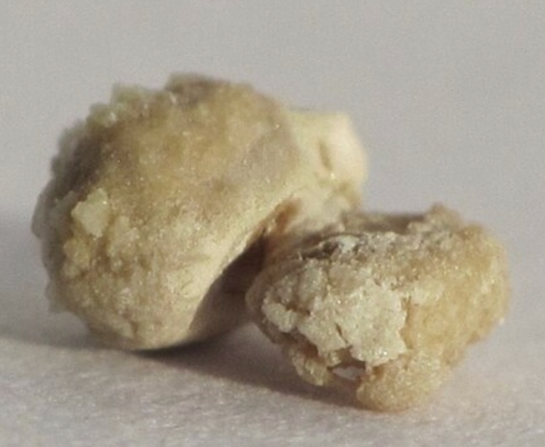 Rubano delle pepite ma erano calcoli renali