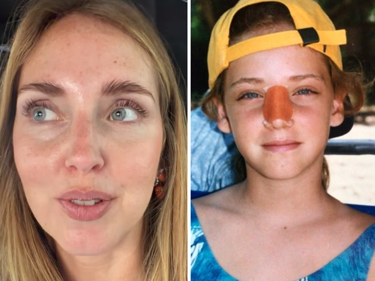 Chiara Ferragni svela la verità sul naso “storto”: cosa le è successo