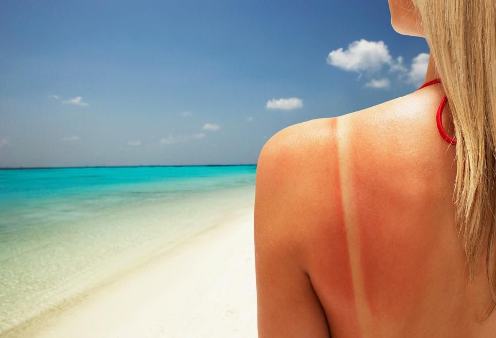 Prime scottature in spiaggia? Ecco il rimedio più efficace (e facilissimo da mettere in pratica)