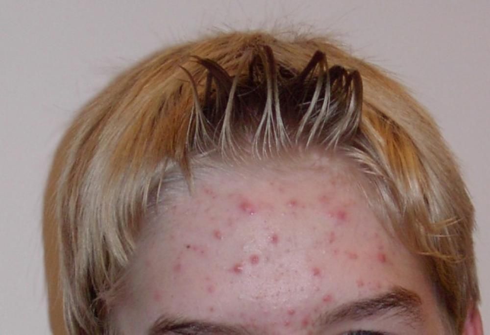 Cosa nascondono i brufoli sul viso